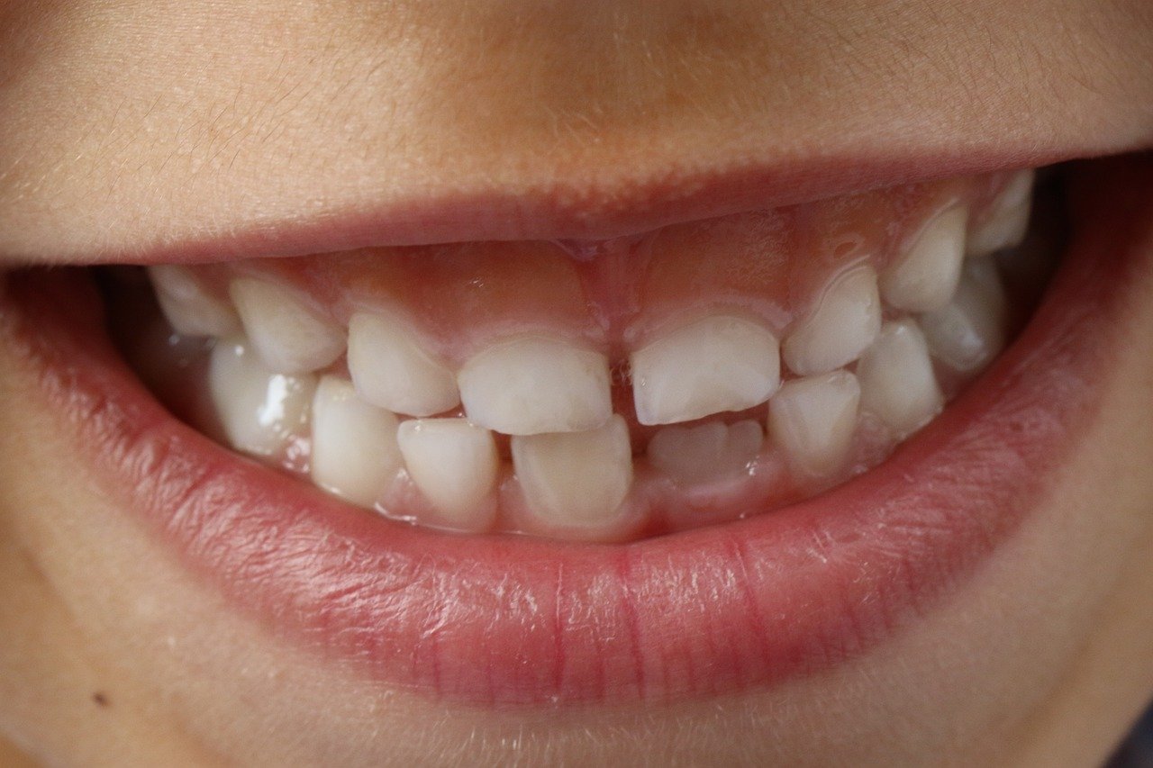 teeth, child smile, child-1743981.jpg